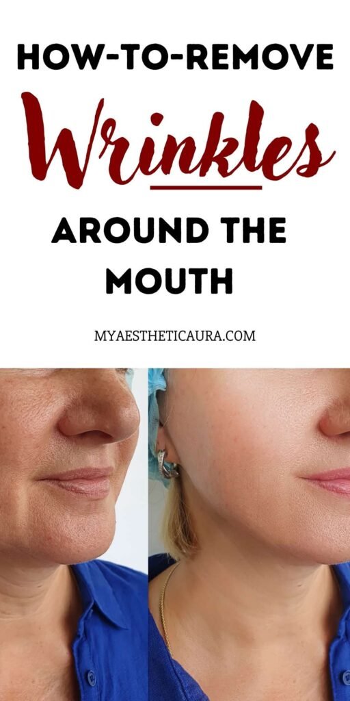 Say Goodbye to Mouth Wrinkles Proven Removal Techniques